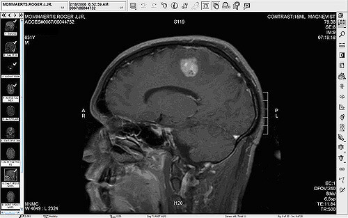 Brain tumor imaging 